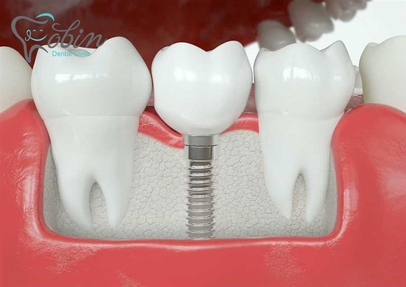 ایمپلنت شامل سه بخش تکیه گاه، دندان مصنوعی و پیچ است که وارد استخوان فک می شود.